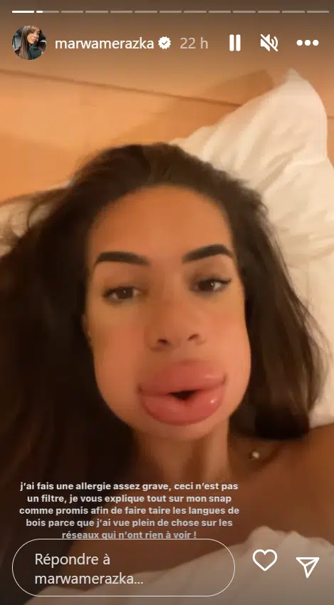 « Ceci n’est pas un filtre », Marwa balance des photos d’elle défigurée juste après plusieurs injections