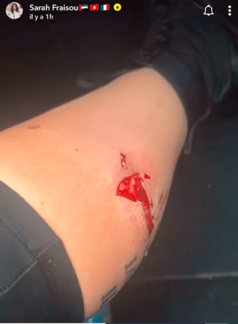 Sarah Fraisou victime d'un grave accident dévoile une photo effroyable