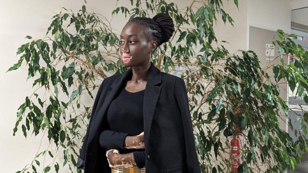 Élection de Miss Normandie 2023 : Estelle Mendy, une candidate qui rayonne malgré son vitiligo !